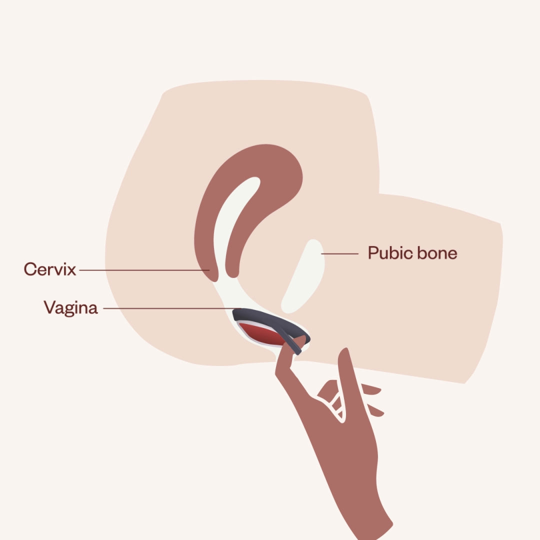 Illustration of a hand removing a DIVA menstrual disc from a vagina using the pull-tab, with labels pointing to the cervix, pubic bone, and vagina in a cross-sectional view of the pelvic area.