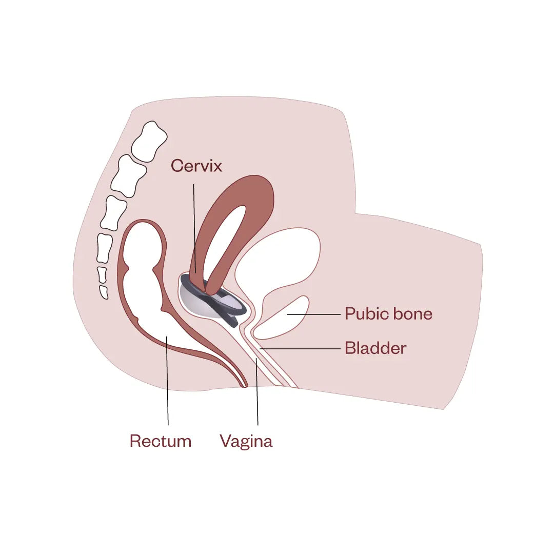 Illustration showing the side view of female pelvic anatomy with a menstrual disc inserted in the vagina below the cervix, near the bladder, pubic bone, and rectum. Labels included.